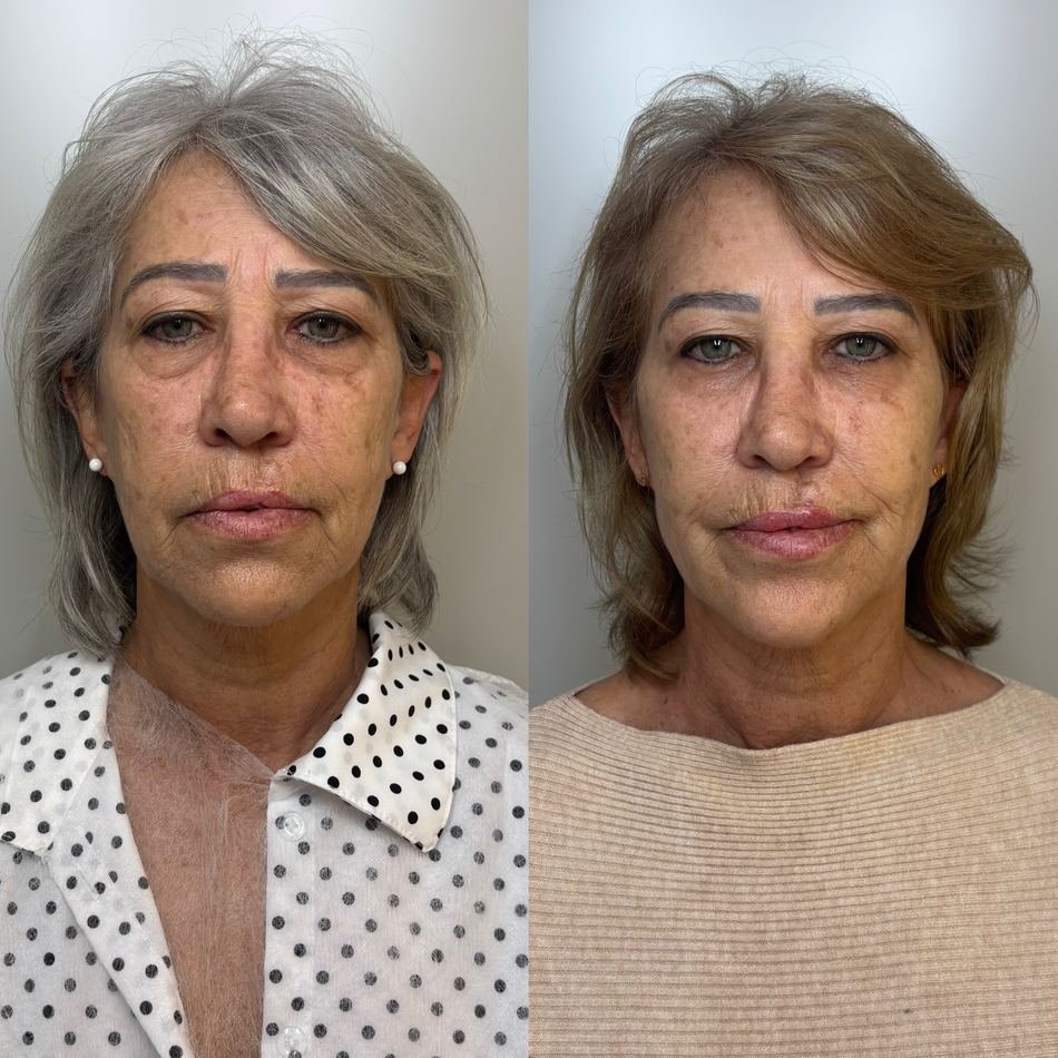 Antes e depois de harmonização facial full face em Novo Hamburgo — vista frontal