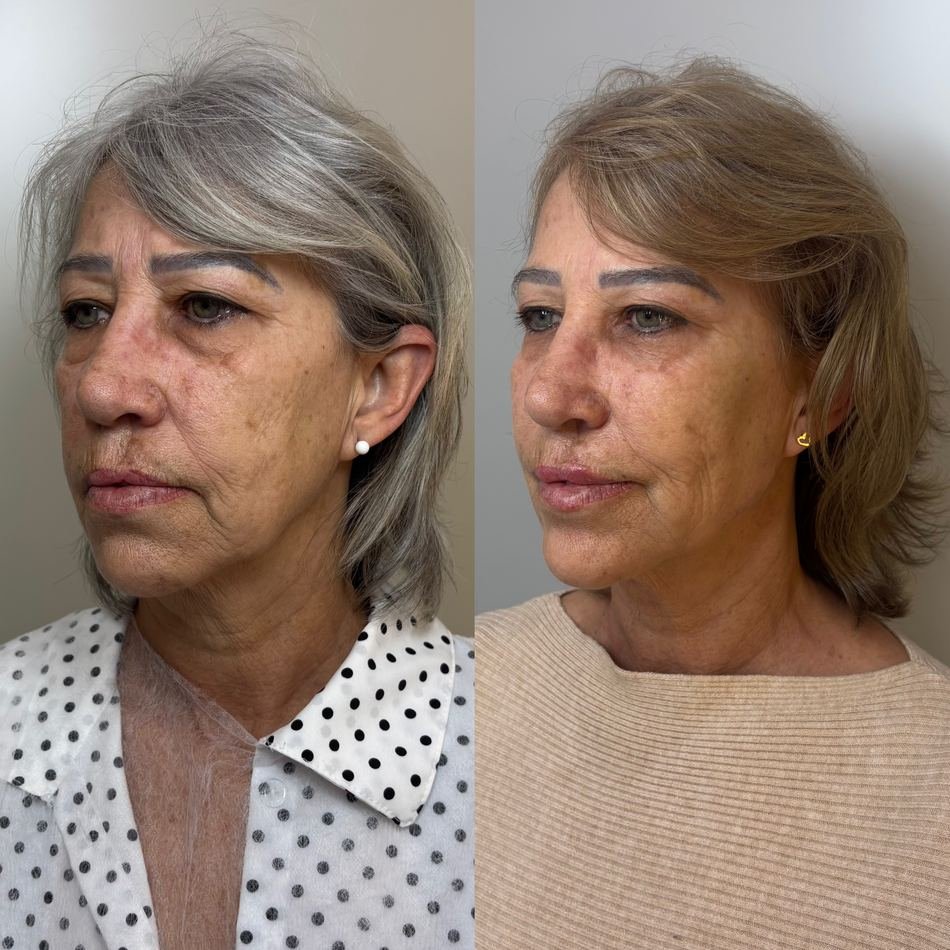 Antes e depois de harmonização facial full face — vista oblíqua