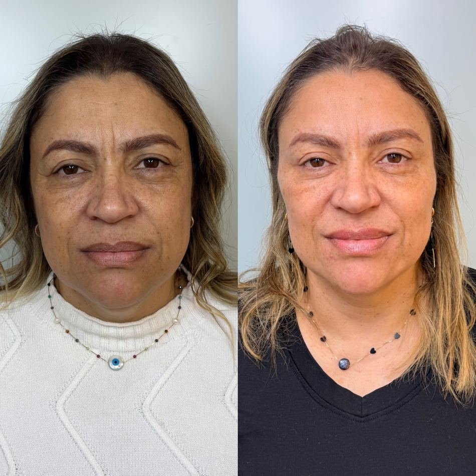 Antes e depois de harmonização facial full face — segunda paciente, vista frontal