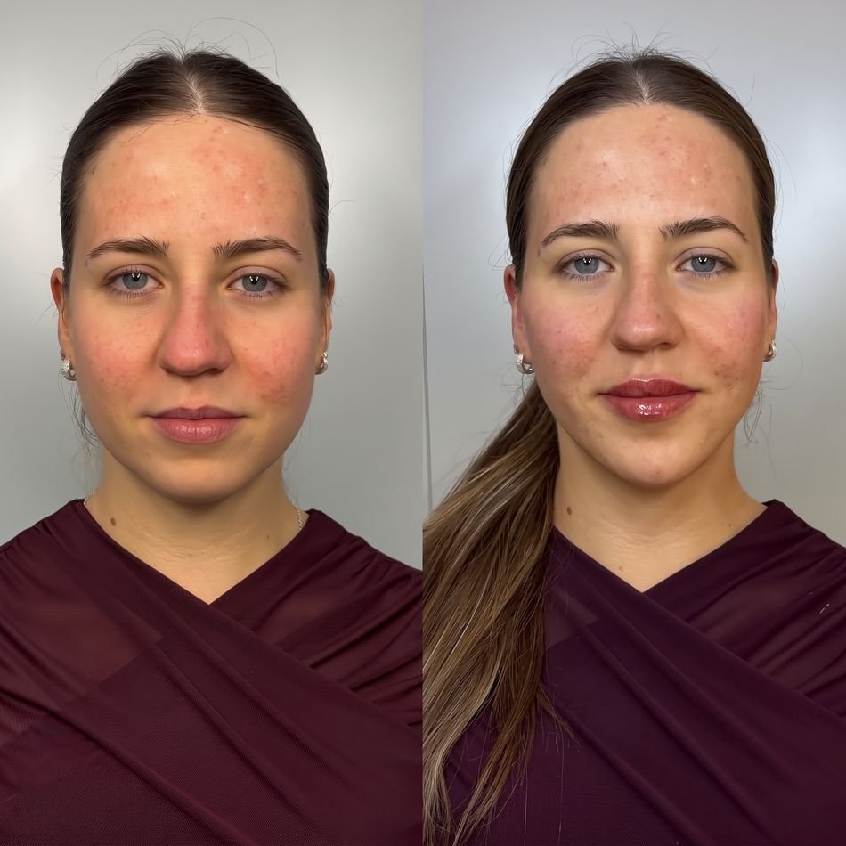 Antes e depois de harmonização facial com preenchimento labial — segunda paciente