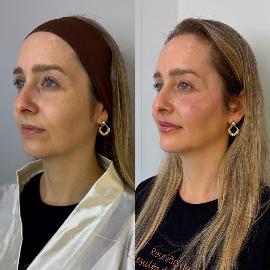 Antes e depois de harmonização facial