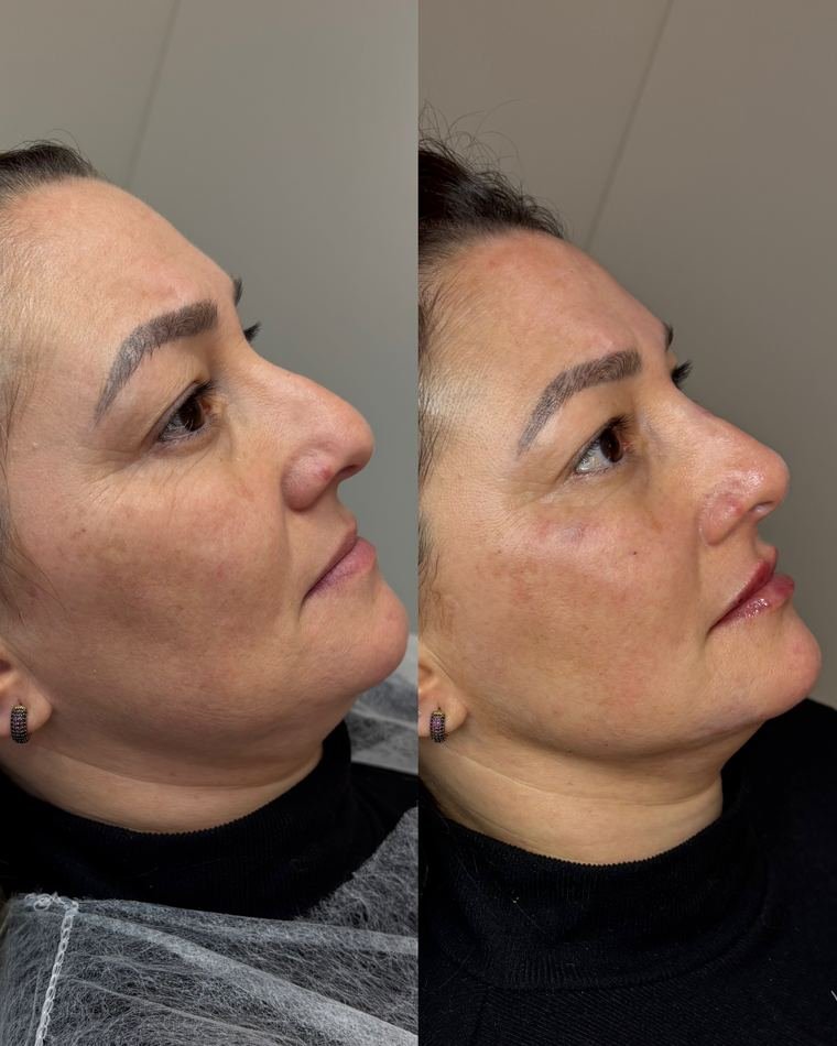 Antes e depois de perfiloplastia — projeção de mento e definição da linha da mandíbula